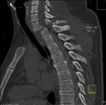 Coluna vertebral.